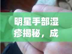 明星手部湿疹揭秘,成因、治疗与预防全攻略