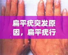 扁平疣突发原因，扁平疣行成原因 
