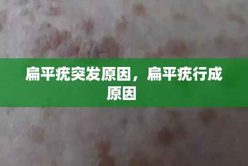 扁平疣突发原因,扁平疣行成原因