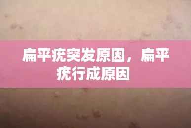 扁平疣突发原因,扁平疣行成原因
