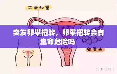 突发卵巢扭转，卵巢扭转会有生命危险吗 