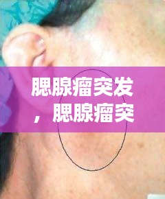 腮腺瘤突发,腮腺瘤突然红肿疼痛