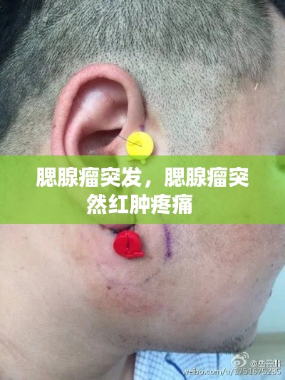腮腺瘤突发,腮腺瘤突然红肿疼痛