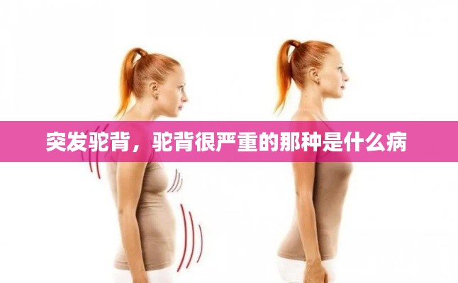 突发驼背，驼背很严重的那种是什么病 